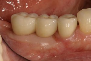 下関市のおおむら歯科医院にて、右下の奥歯にインプラントの治療を行った後の画像